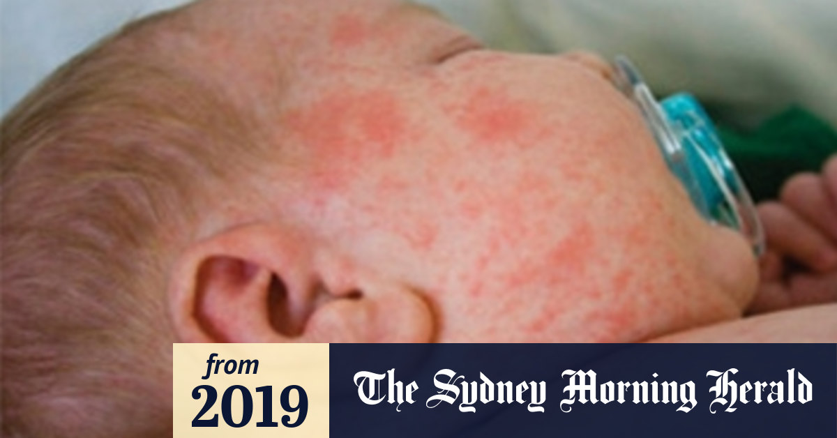 Measles outbreak Babies without vaccinations contract disease, NSW